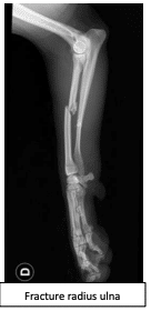 Fracture radius ulna